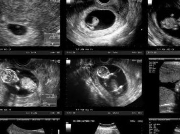 泰国三代试管费用多少？如何避免不必要的支出？